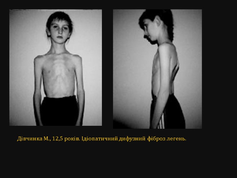 Дівчинка М., 12,5 років. Ідіопатичний дифузний фіброз легень.